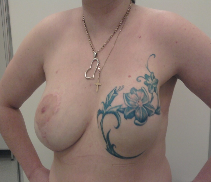 После редукционной маммопластики справа, реконструкции и татуажа слева 